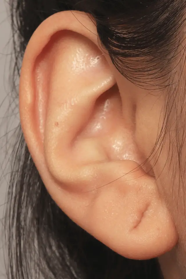 Ear lobe repair