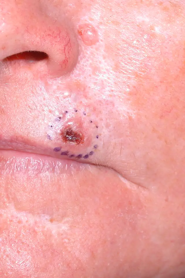 Tumor over skin removal